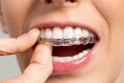 İnvisalign Fiyatları 2017 - Ortonorm Ortodonti