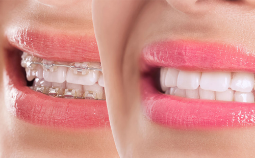 İlk Ortodonti Muayenesi Ne Zaman Yapılmalı?