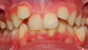 Ortonorm Ortodonti Önce Sonra