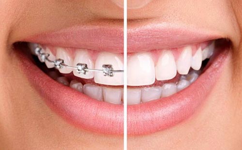 Ortodonti Uzmanlığı Nedir?