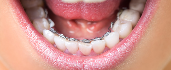 Ortonorm Lingual Ortodonti Tedavisi
