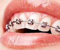 Ortodonti Tedavisinde Diş Bakımı