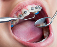 Diş Teli Kırıldığında Ne Yapmalıyız?