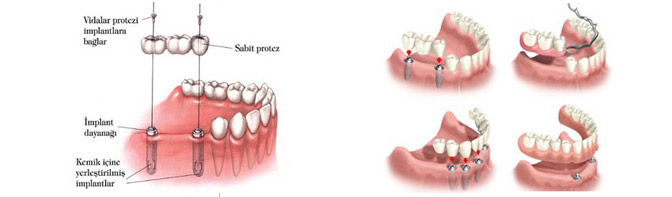 Ortonorm - Diş İmplantları (İmplantoloji)