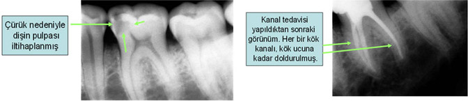 Ortonorm Endodonti Kanal Tedavisi