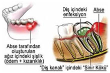 Ortonorm Endodonti Kanal Tedavisi