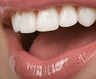 Diş Teli Kullanımında Tahrişi Engelleme